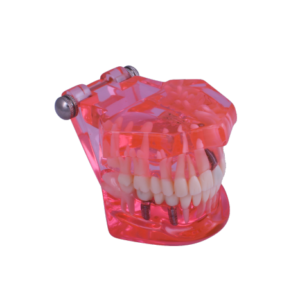 3D Dental Educational Restoration Model W/Implant 