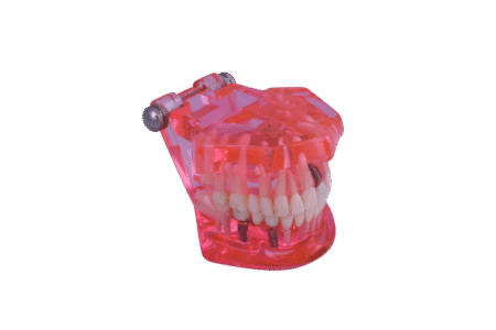 3D Dental Educational Restoration Model W/Implant