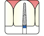 Osung Laminate/ Labial Reduction Chamfer (Taper) FG Shank 194-16M1SS (197TR-SS21) Medium Grit Diamond Bur 5/PK