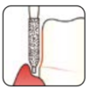 Osung Etcetera Safety/ Gingival FG Shank 255-18M1 (147SRP-018) Medium Grit Diamond Bur 5/PK